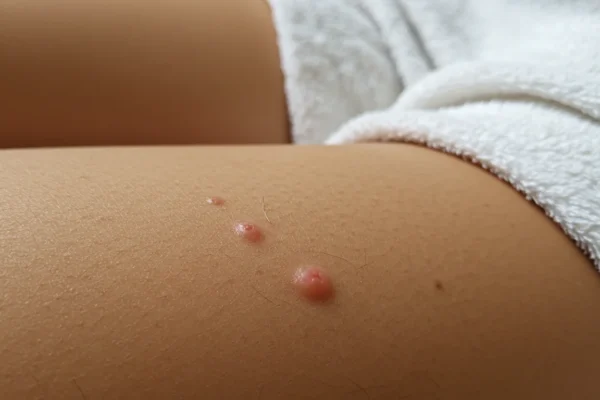 Ingrown Hair Prevention: A $1.5B Shift by 2028