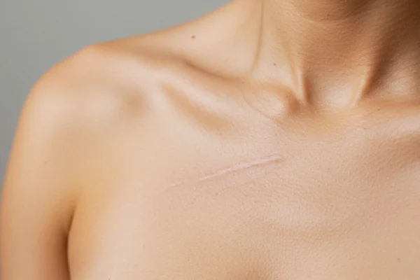 Erase Ingrown Scars: Your 2026 Skin Recovery Plan