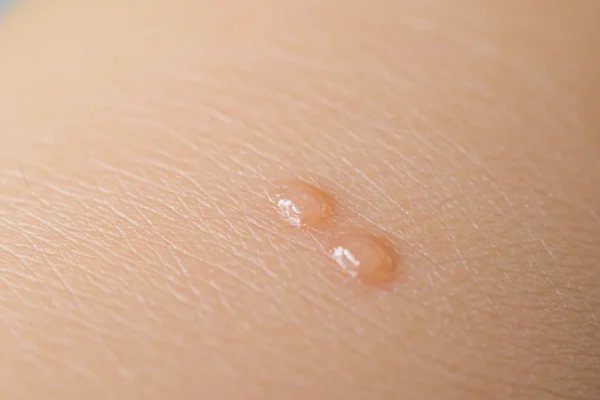 Waxing Bumps: Why Your Skin Needs More in 2026